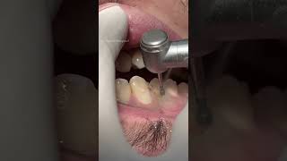 How to fix teeth dentist [upl. by Ainuj]