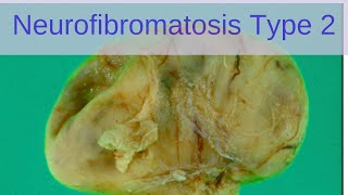 Neurofibromatosis Type 2 NF2  Pathology mini tutorials [upl. by Josiah]