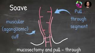 Anatimations Surgical Options for Hirschsprung Disease [upl. by Eisnil]