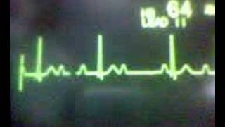 ECG Video AV Block  Second Degree Type 1 Wenckebach [upl. by Leunamesoj]