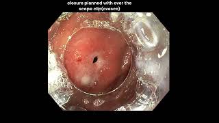 Duodenal perforation Endoscopic closure with ovesco OTSC [upl. by Ameerahs]