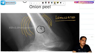 Ewings Sarcoma Hindi  Orthopedics Lecture [upl. by Oremo]