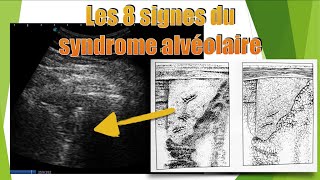 8 aspects de pneumopathie en échographie [upl. by Revlys]