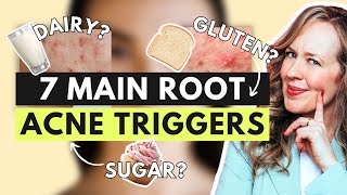 This is why youre breaking out 7 Main Acne Triggers REVEALED [upl. by Ecadnac347]