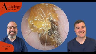 EAR WAX REMOVAL COMPILATION INC LONG KERATIN STRIPS amp WAX PLUGS EP819 [upl. by Kristianson]