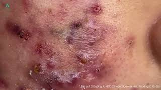 Big Cystic Acne Blackheads Extraction Blackheads amp Milia Whiteheads Removal Pimple Popping [upl. by Nnylsor207]