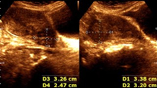 Three cases of Leiomyoma Uterus  Abnormal Uterine Bleeding  sonographic prediction [upl. by Alyag]