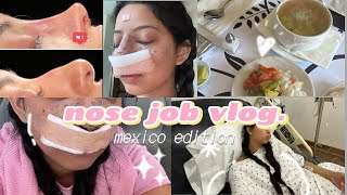 I GOT A RHINOPLASTY IN MEXICO [upl. by Namyl762]