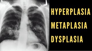 Hyperplasia Metaplasia amp Dysplasia Explained Cancer Biology [upl. by Concepcion102]