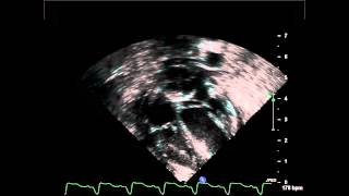 Balloon Atrial Septostomy Subcostal Coronal View [upl. by Carlita]