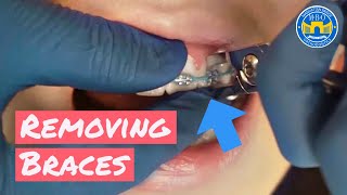 Process of Removing Braces [upl. by Adlanor]