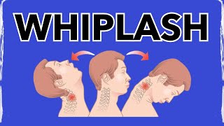 Whiplash A Physical Therapy SECRET for Treating [upl. by Formenti153]