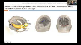 Bioelektromagnetismus Anwendung in d prächirurgischen EpilepsieDiagnose C Wolters Uni Münster [upl. by Remington]