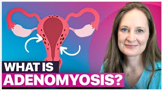 Adenomyosis EXPLAINED Symptoms You Cant Ignore  Treatment Options [upl. by Ocer]