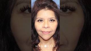 Buccal Fat Removal Cheek Reduction [upl. by Carlynn]