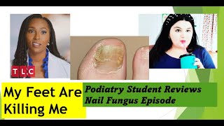 Podiatry Student reviews Brandon Never Washes His Feet  My Feet Are Killing Me nailfungus [upl. by Casar]