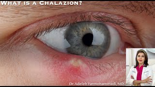 What is a Chalazion quotWhat is that red bump on my eyelidquot [upl. by Aynatal]