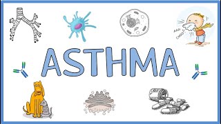 Asthma  Pathogenesis Types Clinical Presentation Morphology Diagnosis and Treatment [upl. by Anaihk]