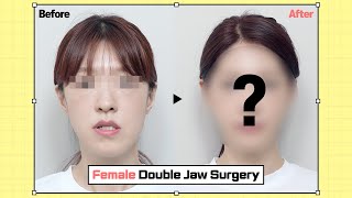 Female Double Jaw Surgery Before amp After  Post OP 6Months 両顎手術 輪郭手術 [upl. by Dearr]