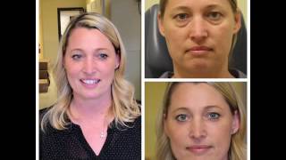 Lower Blepharoplasty Patient  Beautiful Results [upl. by Mcmillan]