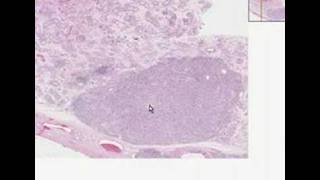 Histopathology TestisSeminoma [upl. by Aleen]