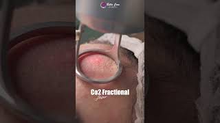 Co2 Fractional laser for pigmentation at BellaCareAesthetics johartownlahore scars acne clean [upl. by Celinka879]