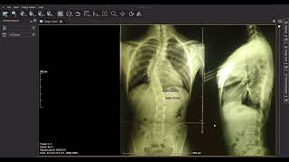 ¿Como medimos una escoliosis en el WEASIS [upl. by Ydnerb53]