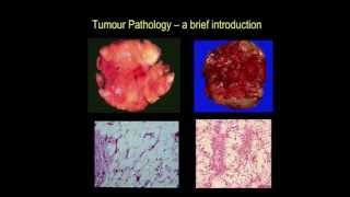 Tumour pathology  a brief introduction part III [upl. by Isaacson]