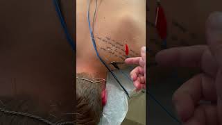 Dry Needling with Electrostimulation for Rotator Cuff Shoulder and Neck Pain Relief dryneedling [upl. by Kevyn93]