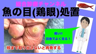 魚の目鶏眼処置 総合診療チャンネル 魚の目鶏眼総合診療＃地域医療 [upl. by Assiluj]