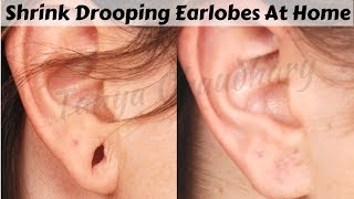 Top 3 Home Remedies To Shrink Drooping Earlobes Naturally At Home  100 Effective Home Remedies [upl. by Yecam478]