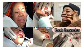 4 Teeth 🦷 Extracted For Braces  premolar Extractions Pt1 [upl. by Borries449]