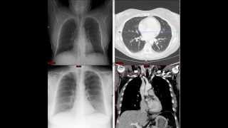 Radiology of the Thorax [upl. by Etakyram]