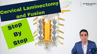 Posterior Cervical Laminectomy and Fusion  Procedure details recovery and expectations [upl. by Elana]