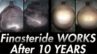 10 YEARS ON FINASTERIDE Results of Italian Study [upl. by Purington756]