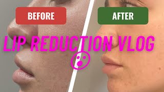 Lip Reduction Surgical Procedure vlog including Side Effects and footage of full process [upl. by Brinn]