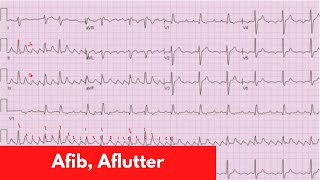 AFib Aflutter MAT  For DO MD NP PA Part 5 [upl. by Esidnak743]