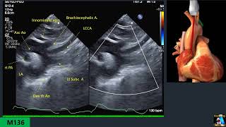 Pediatric Echo Transthoracic Protocol Part 6 Suprasternal SSN [upl. by Atinas359]