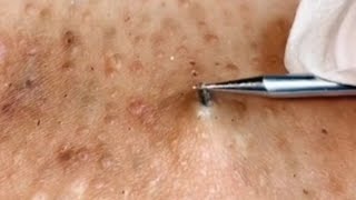 ingrown hair removal 😌 [upl. by Nagek634]