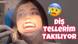 DİŞ TELLERİM TAKILIYOR  VLOG TuanaZeybek [upl. by Tnomed]