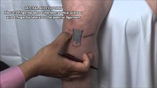 Knee Injection  Anterior Approach [upl. by Nailluj]