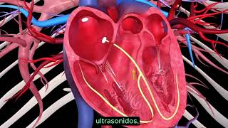 Cardiopatía isquémica [upl. by Candi44]