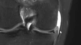 Knee MRI scan  Medial Collateral Ligament Anatomy MCL and medial meniscus tear [upl. by Dill10]