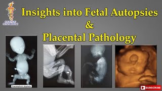 Insights into Fetal Autopsies and Placental Pathology [upl. by Tegirb738]