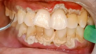 Dental Scaling of Tartar Affecting Gums Badly🤢🥵 Amazing Results after Plaque Removal Dr Ram MDS [upl. by Ijneb]