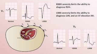 Intro to EKG Interpretation  Bundle Branch Blocks [upl. by Sisson]