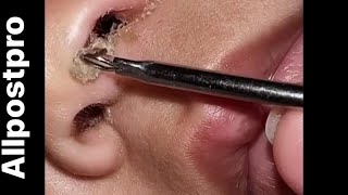 Cleaning baby nose 😍 Super satisfying [upl. by Acirej]