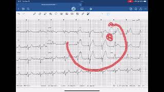 Sgarbossa Criteria Example Paced Rhythm [upl. by Denys576]