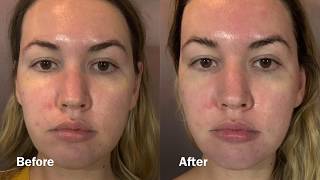 Cryoskin 30 Toning Facial at Deify Laser  Beauty Lounge [upl. by Vipul]