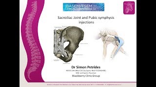 Sacroiliac Joint Injections and prolotherapy [upl. by Nilo]